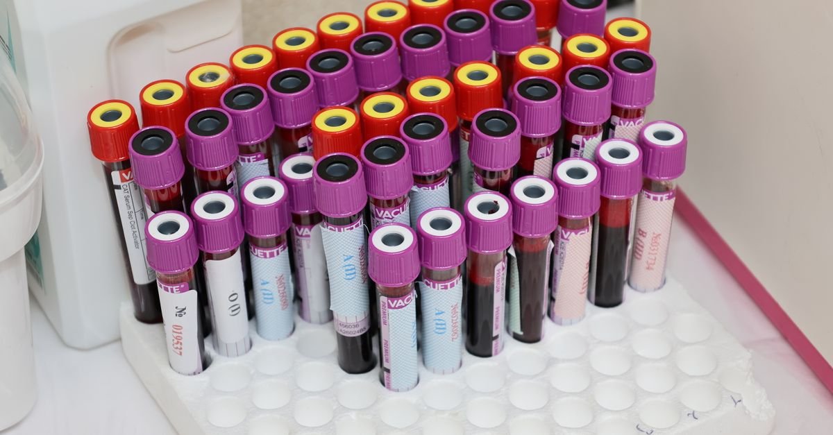 A blood sample vial in a laboratory
